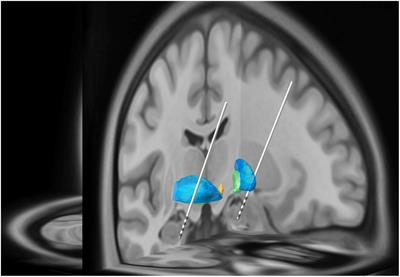 Acute Effects and the Dreamy State Evoked by Deep Brain Electrical Stimulation of the Amygdala: Associations of the Amygdala in Human Dreaming, Consciousness, Emotions, and Creativity